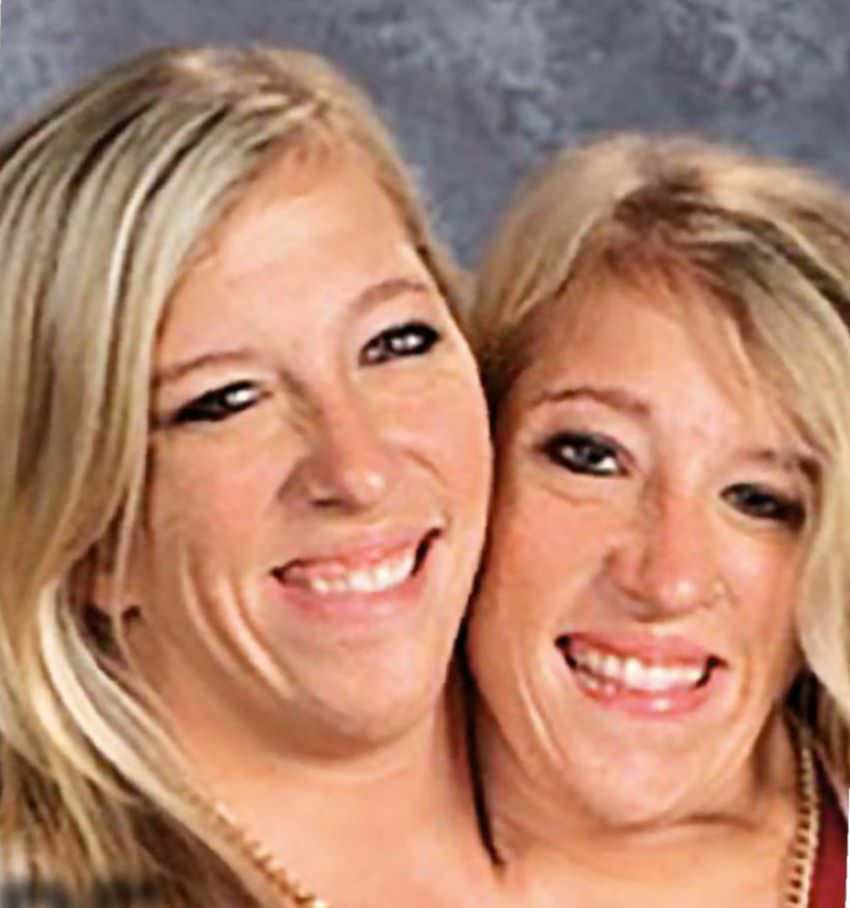 Conjoined Twins Brittany And Abby Hensel Are Married? in 2023