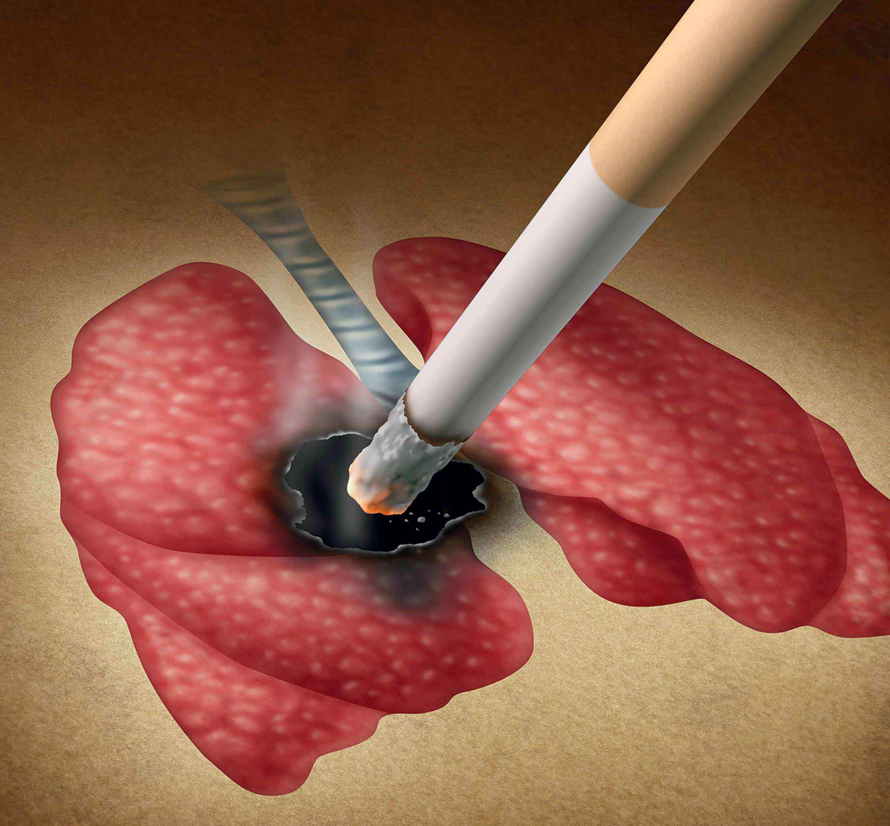 Lung Cancer- Risks and Prevention