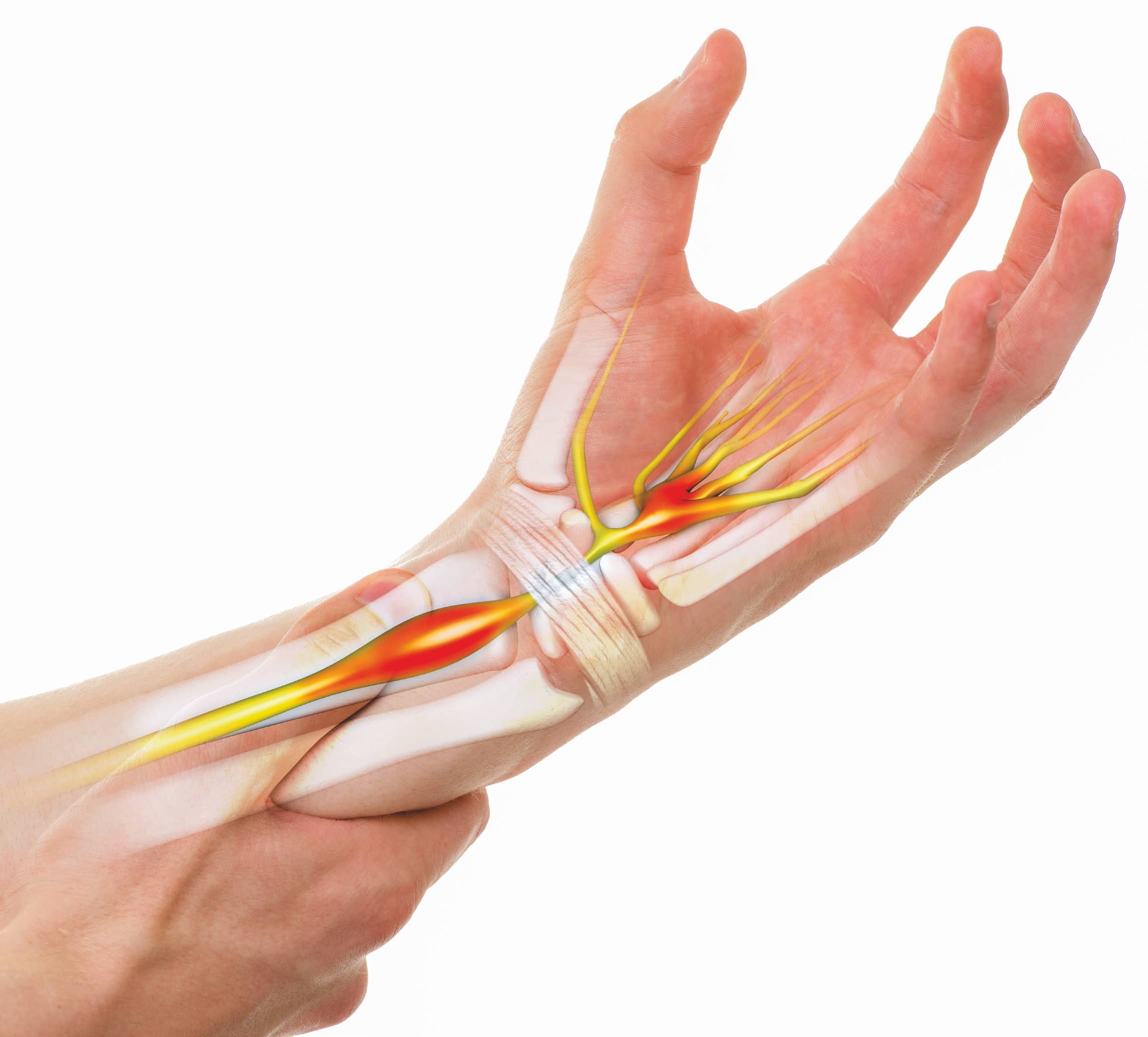 understanding-carpal-tunnel-syndrome