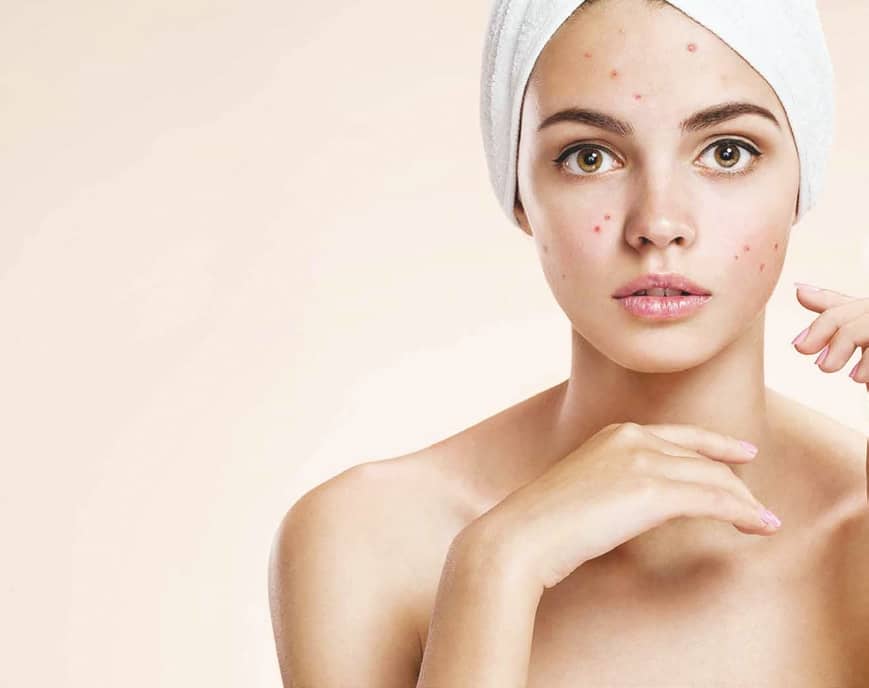 Adieus Acne!