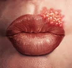The Hidden Dangers Of Herpes