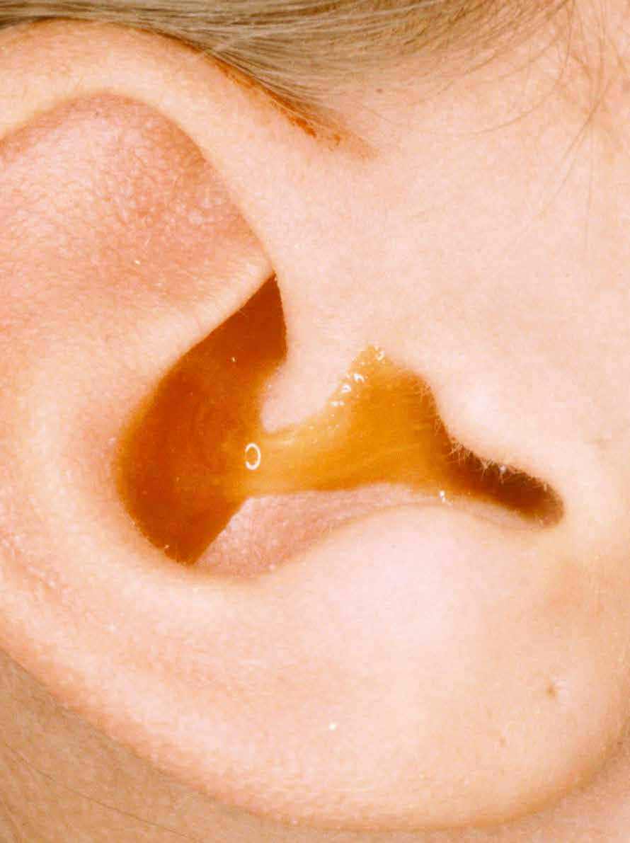 ear-drainage-otorrhea